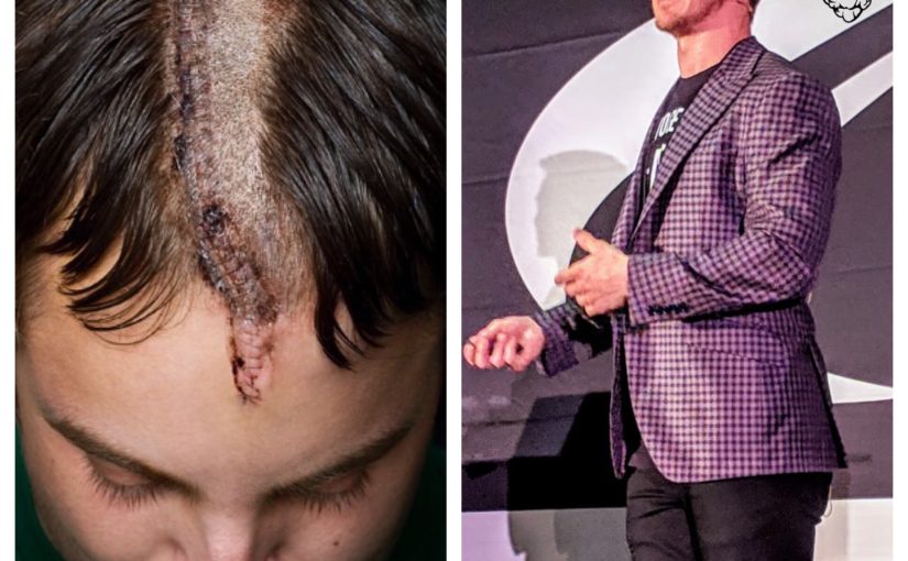 75 staples in my head taught me perspective
